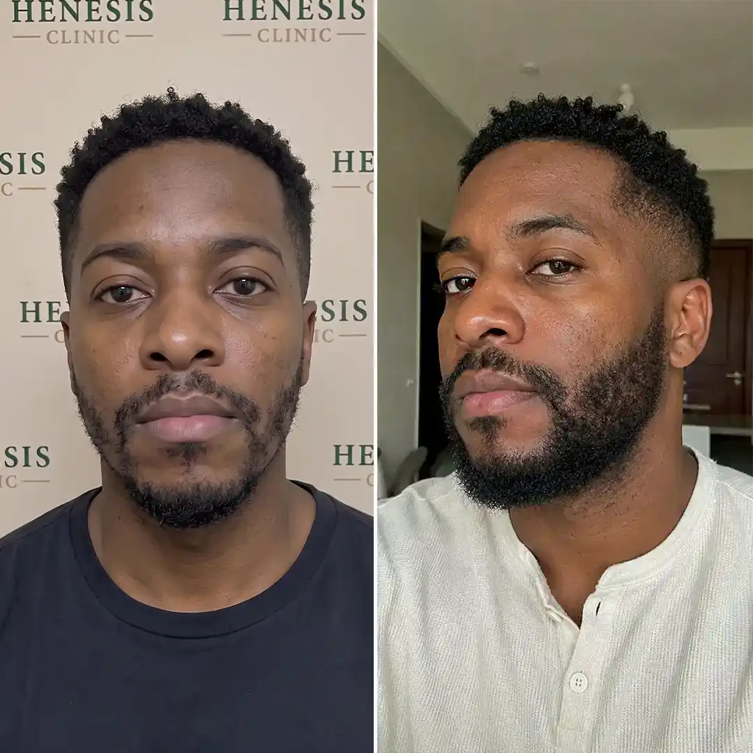 Before-treatment and 12-month follow-up photographs from documented case HNS-0001