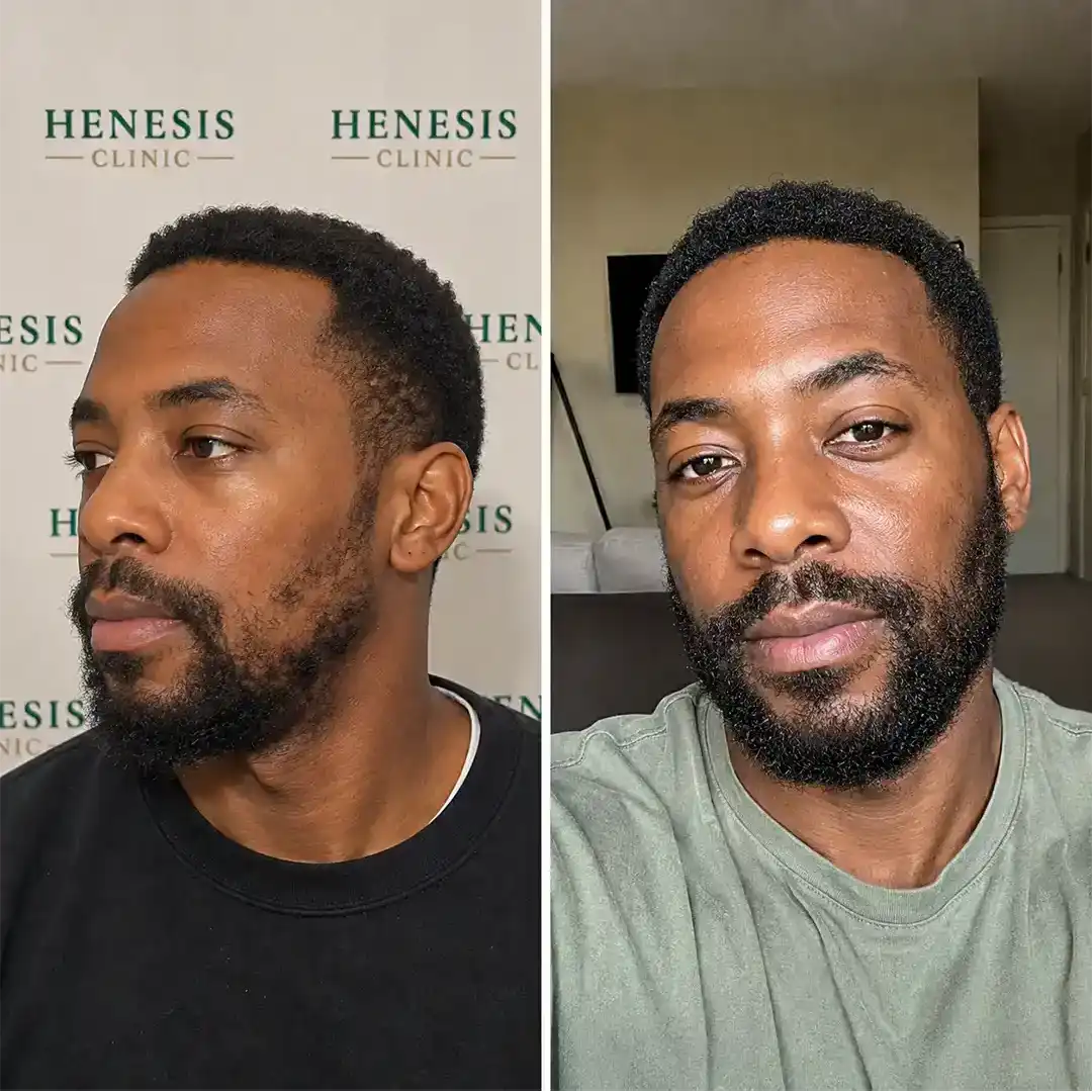 Before-treatment and 12-month follow-up photographs from documented case HNS-0006