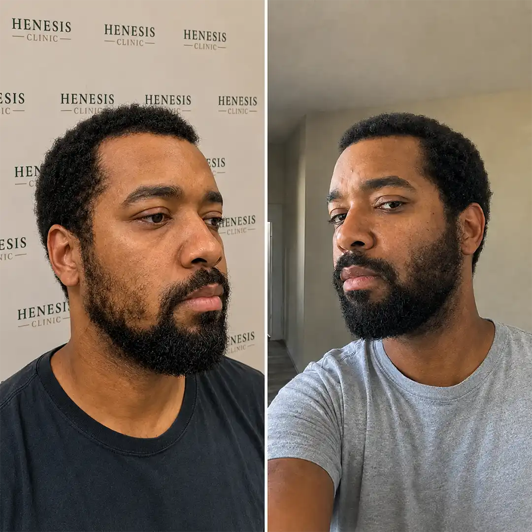 Before-treatment and 12-month follow-up photographs from documented case HNS-0007