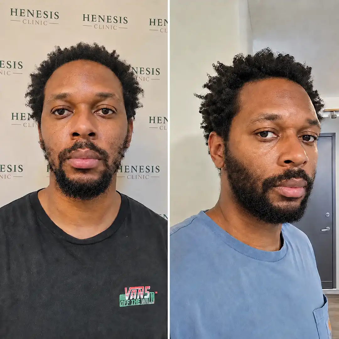 Before-treatment and 12-month follow-up photographs from documented case HNS-0008