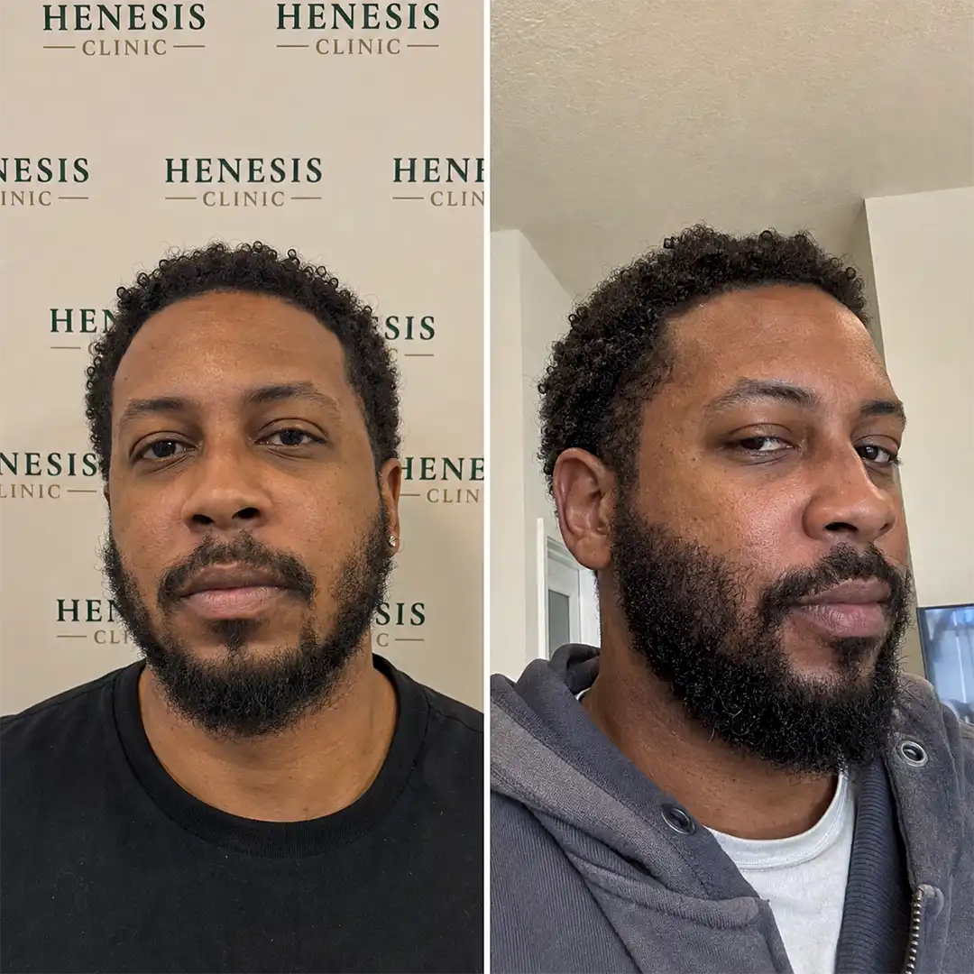 Before-treatment and 12-month follow-up photographs from documented case HNS-0009