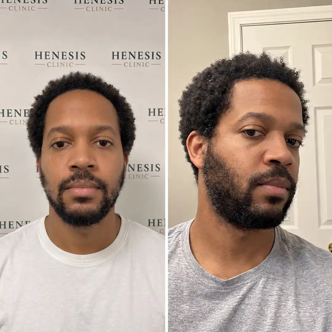 Before-treatment and 12-month follow-up photographs from documented case HNS-0010
