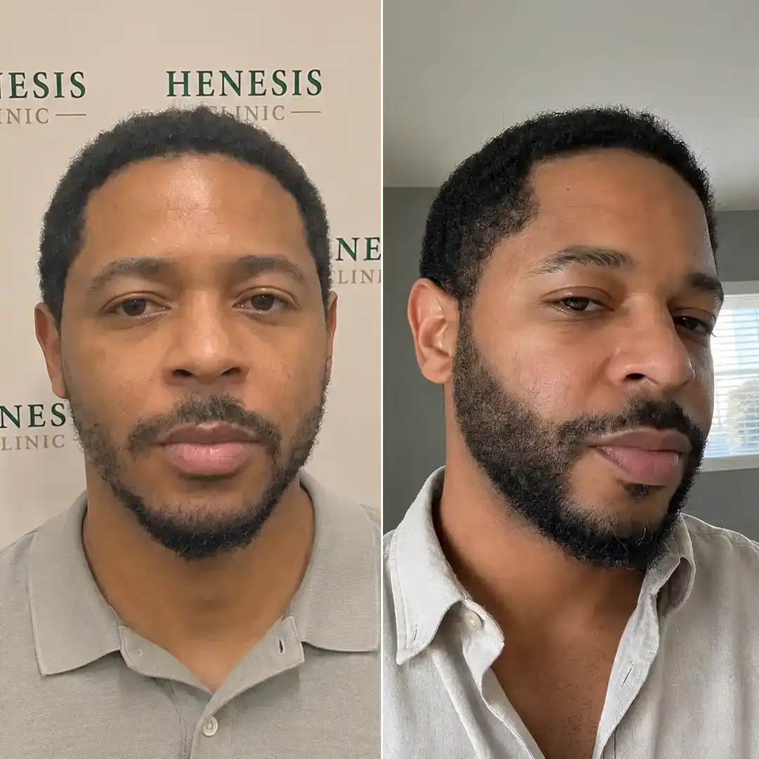 Before-treatment and 12-month follow-up photographs from documented case HNS-0011