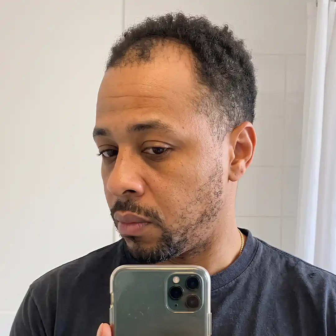 Fotografia prima del trattamento, vista frontale, caso documentato HNS-0016