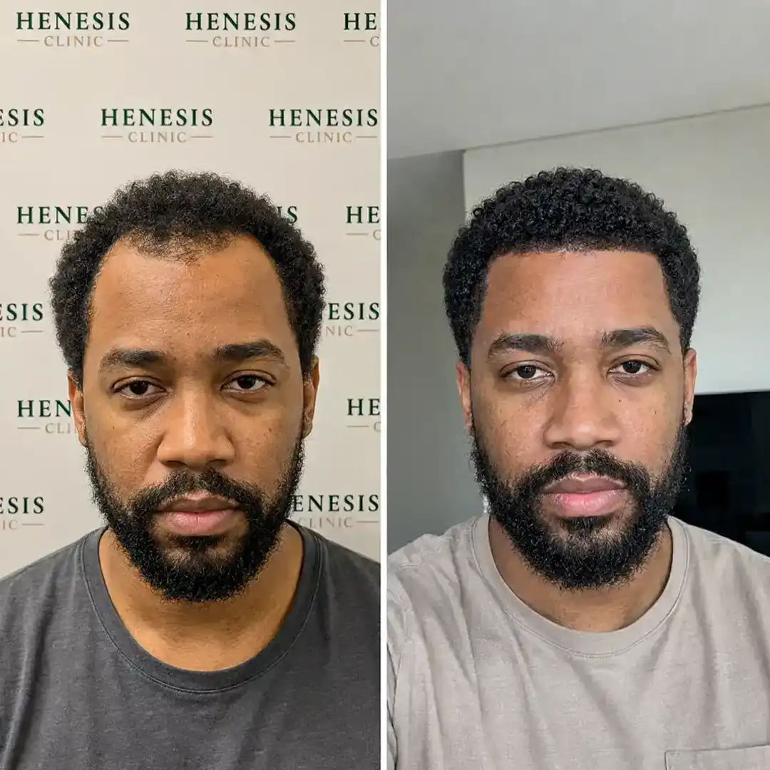 Before-treatment and 12-month follow-up photographs from documented case HNS-0018