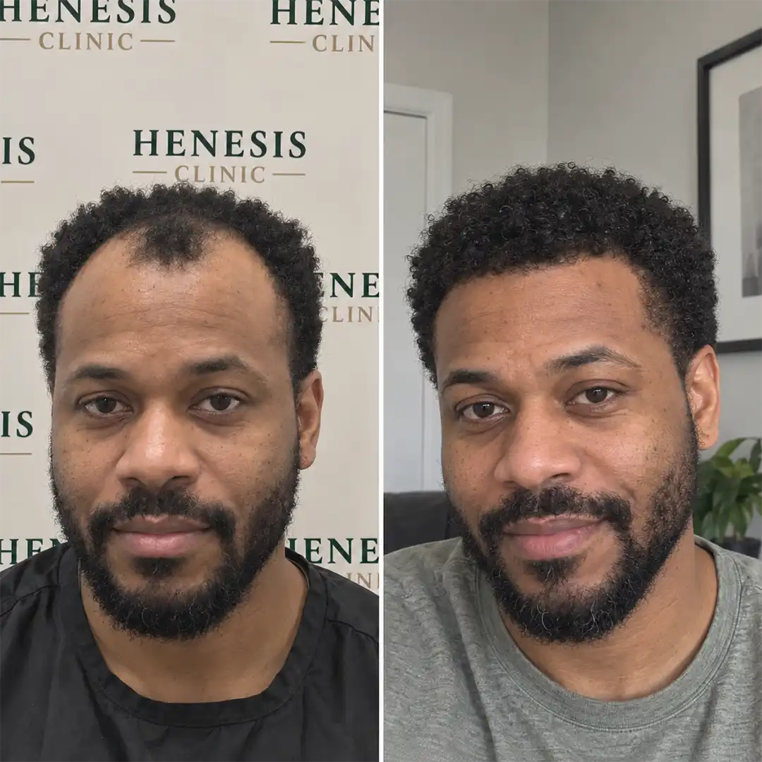 Before-treatment and 12-month follow-up photographs from documented case HNS-0019