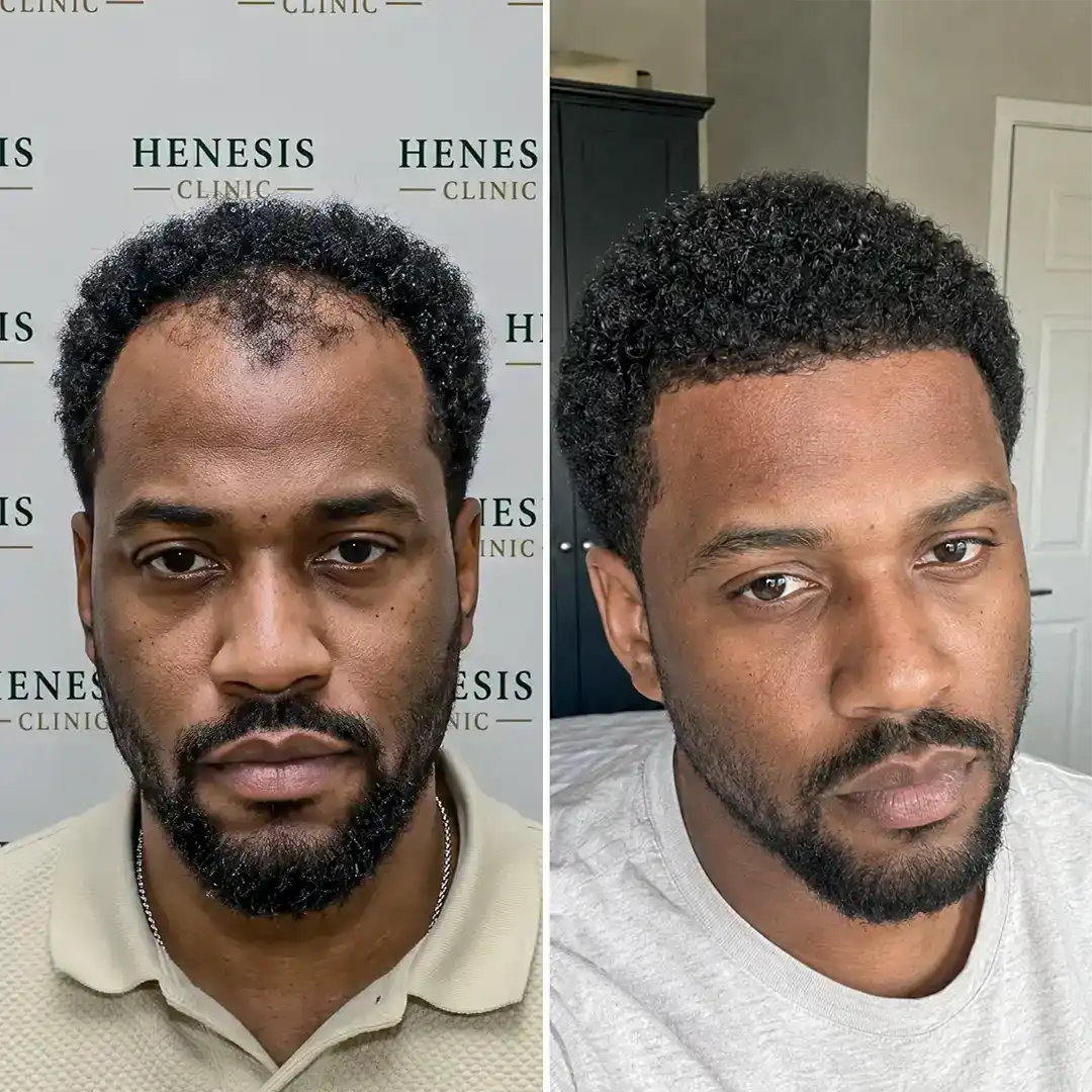 Before-treatment and 12-month follow-up photographs from documented case HNS-0020