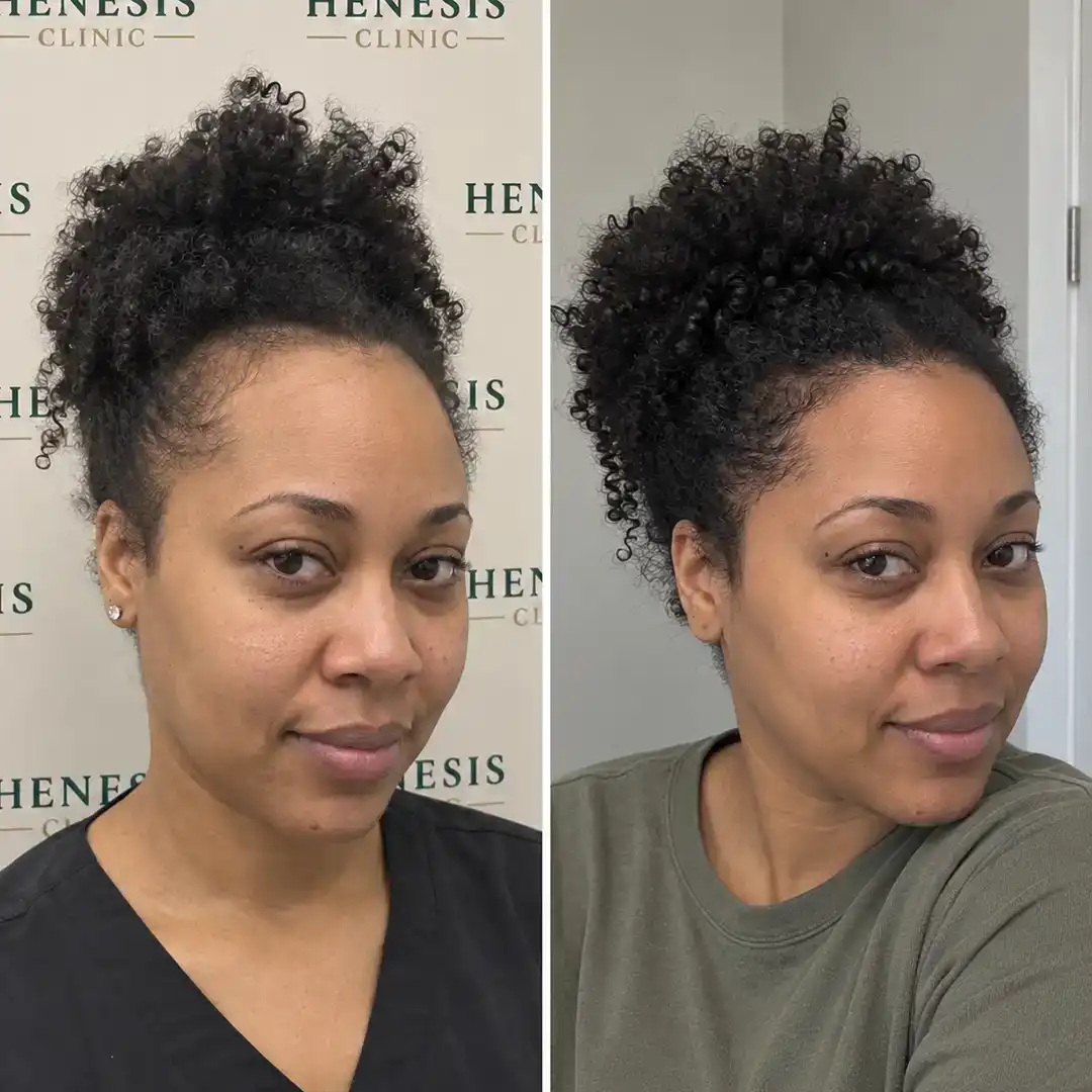 Before-treatment and 12-month follow-up photographs from documented case HNS-0021