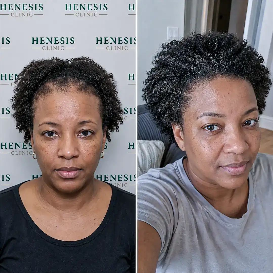 Female Afro hair transplant before and after — 2,550 grafts, DHI, 12-month follow-up, case HNS-0029
