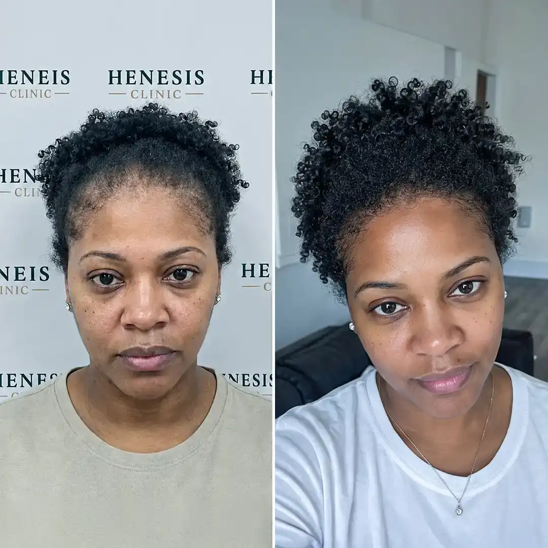 Female Afro hair transplant before and after — 2,800 grafts, Sapphire FUE, 12-month follow-up, case HNS-0031