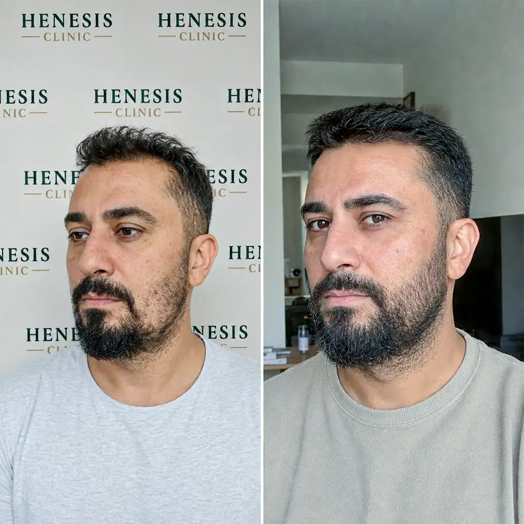 Before-treatment and 12-month follow-up photographs from documented case HNS-0032