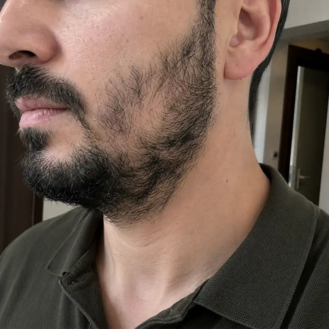 Transplant de barbă cu 2.200 de grefe — vedere din stânga înainte de procedură