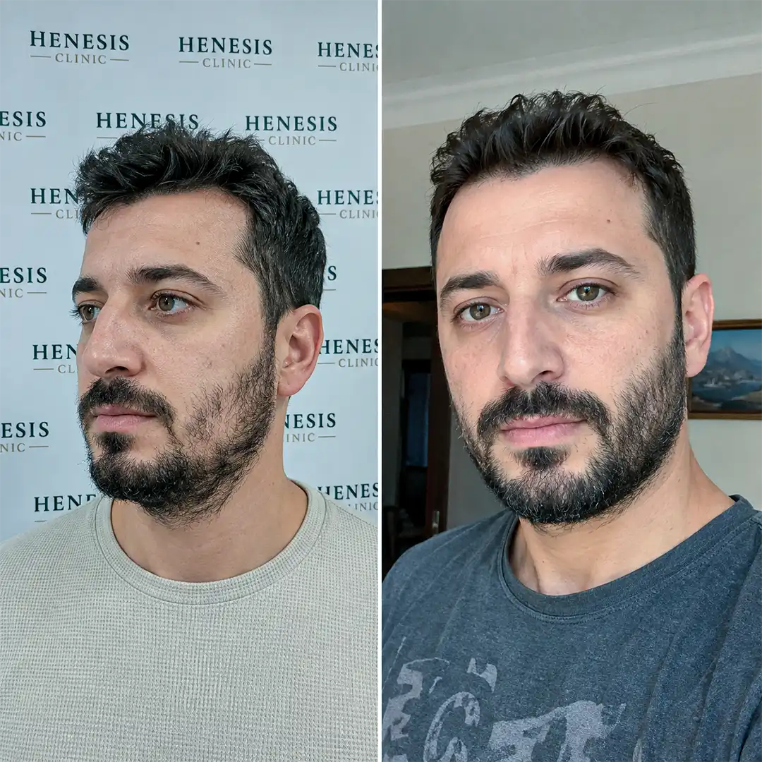 Comparație înainte și după la 12 luni — cazul HNS-0033