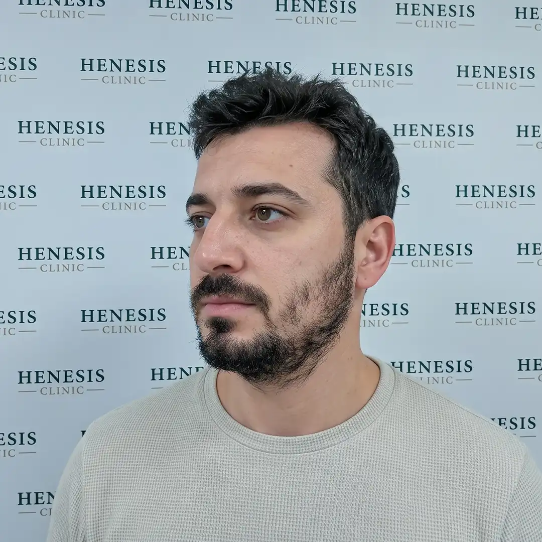 Transplant de barbă cu 2.200 de grefe — vedere din stânga în timpul procedurii