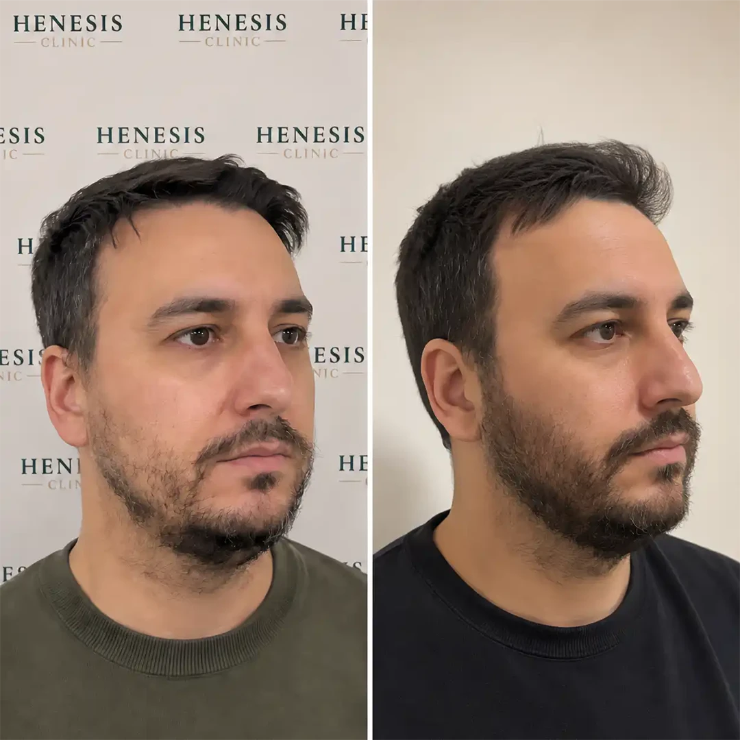 Before-treatment and 12-month follow-up photographs from documented case HNS-0034