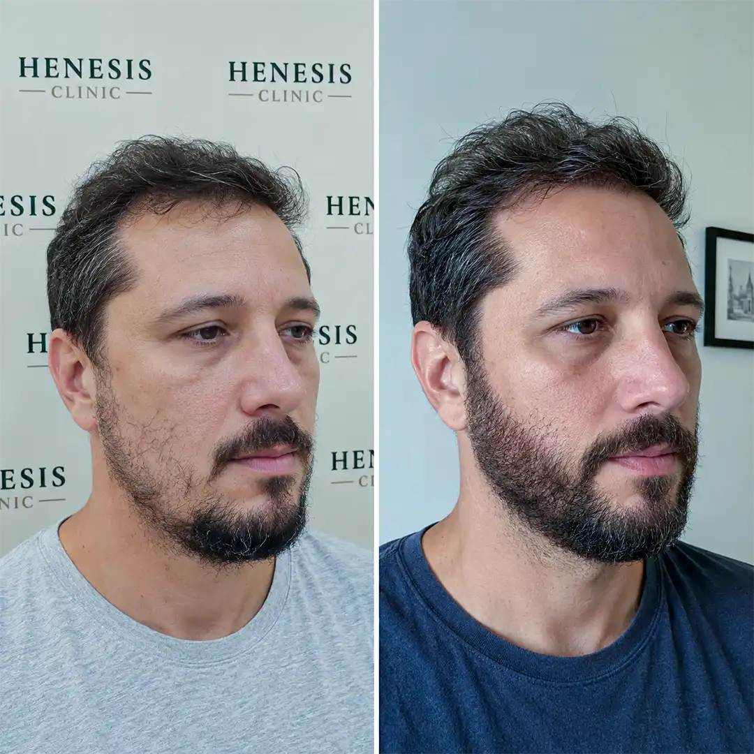 Before-treatment and 12-month follow-up photographs from documented case HNS-0035