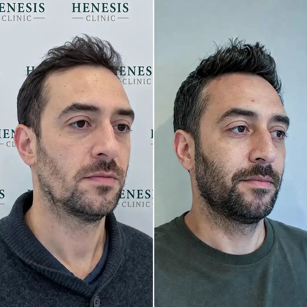 Before-treatment and 12-month follow-up photographs from documented case HNS-0036