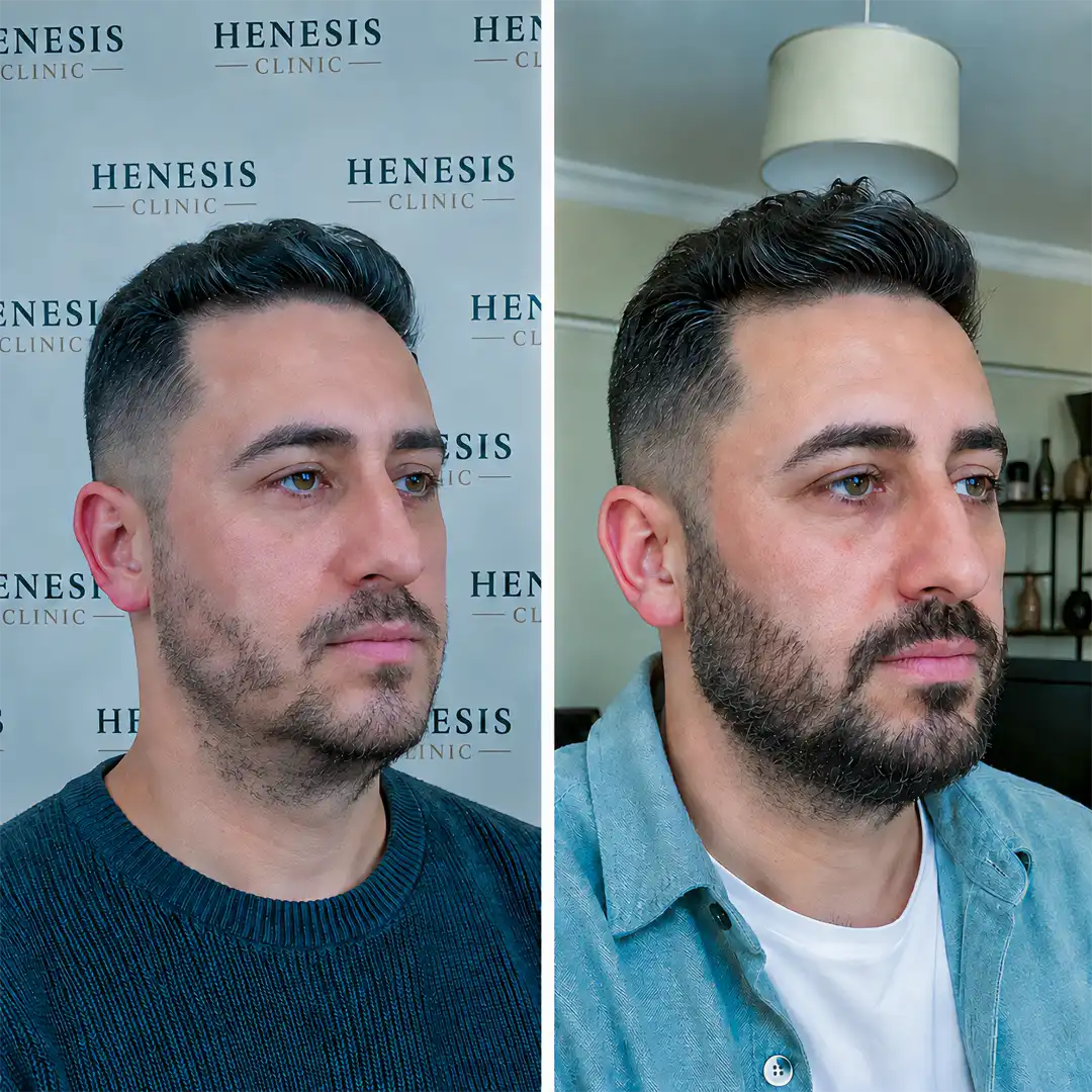 Before-treatment and 12-month follow-up photographs from documented case HNS-0037