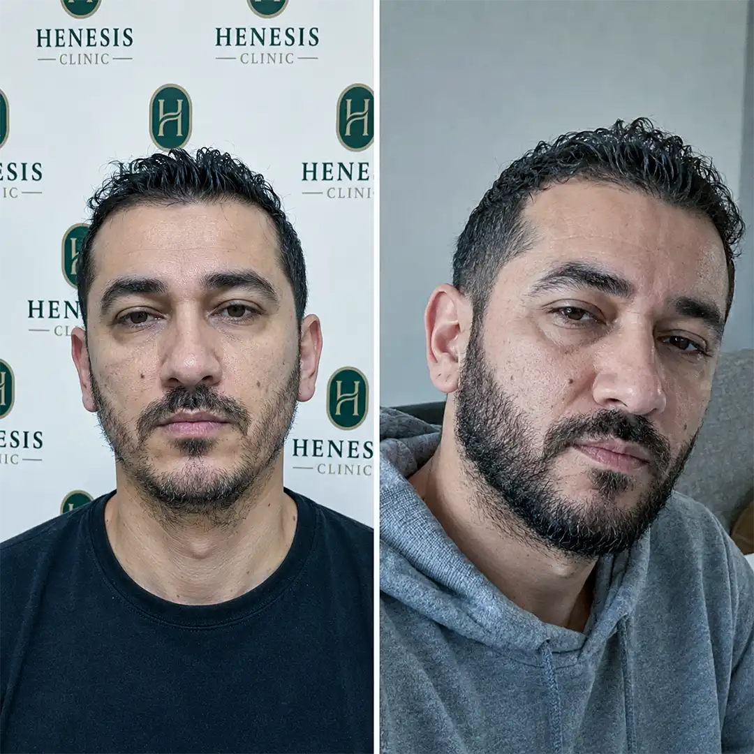 Before-treatment and 12-month follow-up photographs from documented case HNS-0038