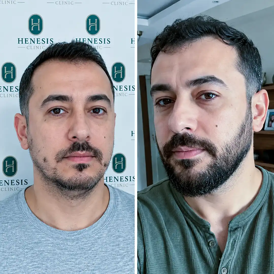 Before-treatment and 12-month follow-up photographs from documented case HNS-0039