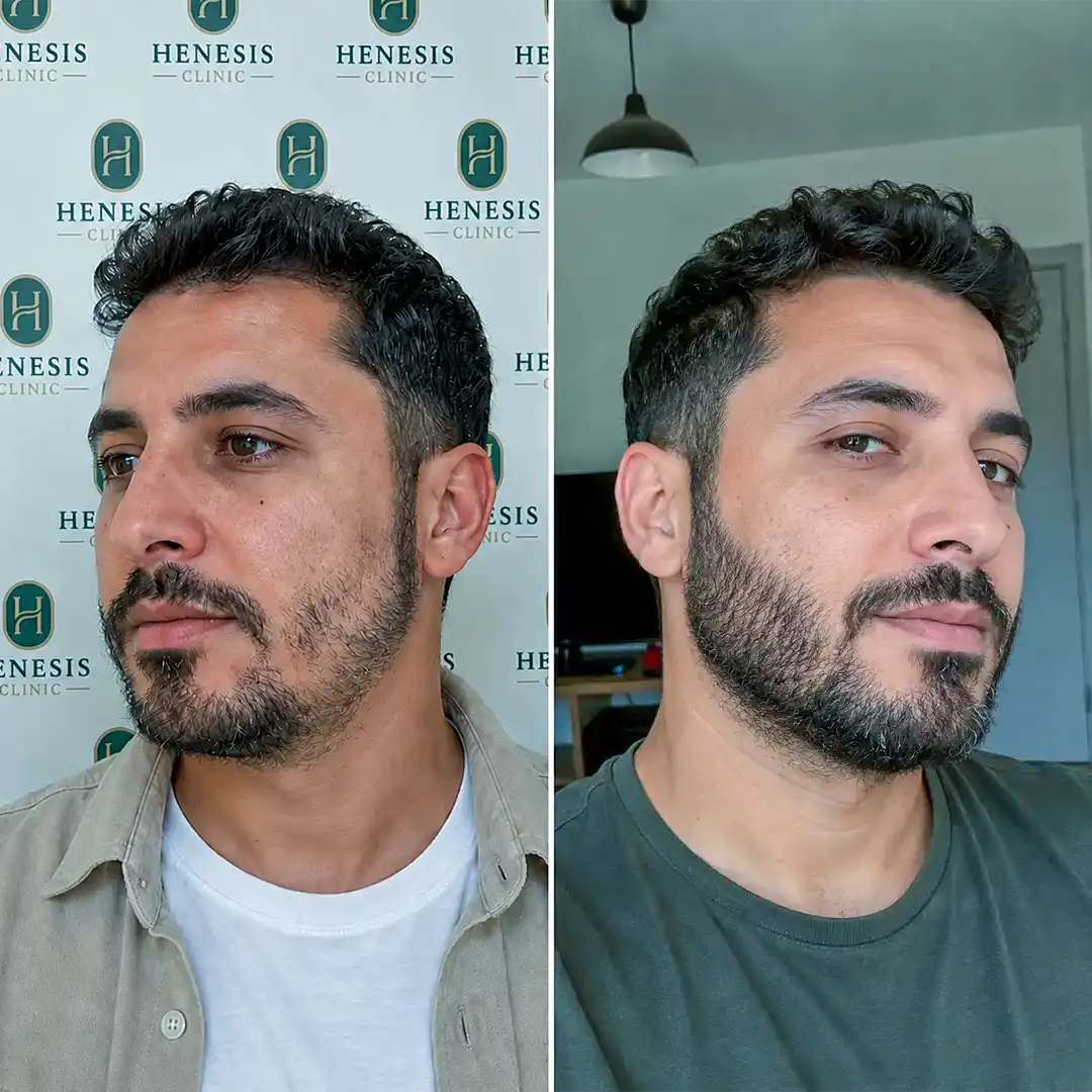 Before-treatment and 12-month follow-up photographs from documented case HNS-0040