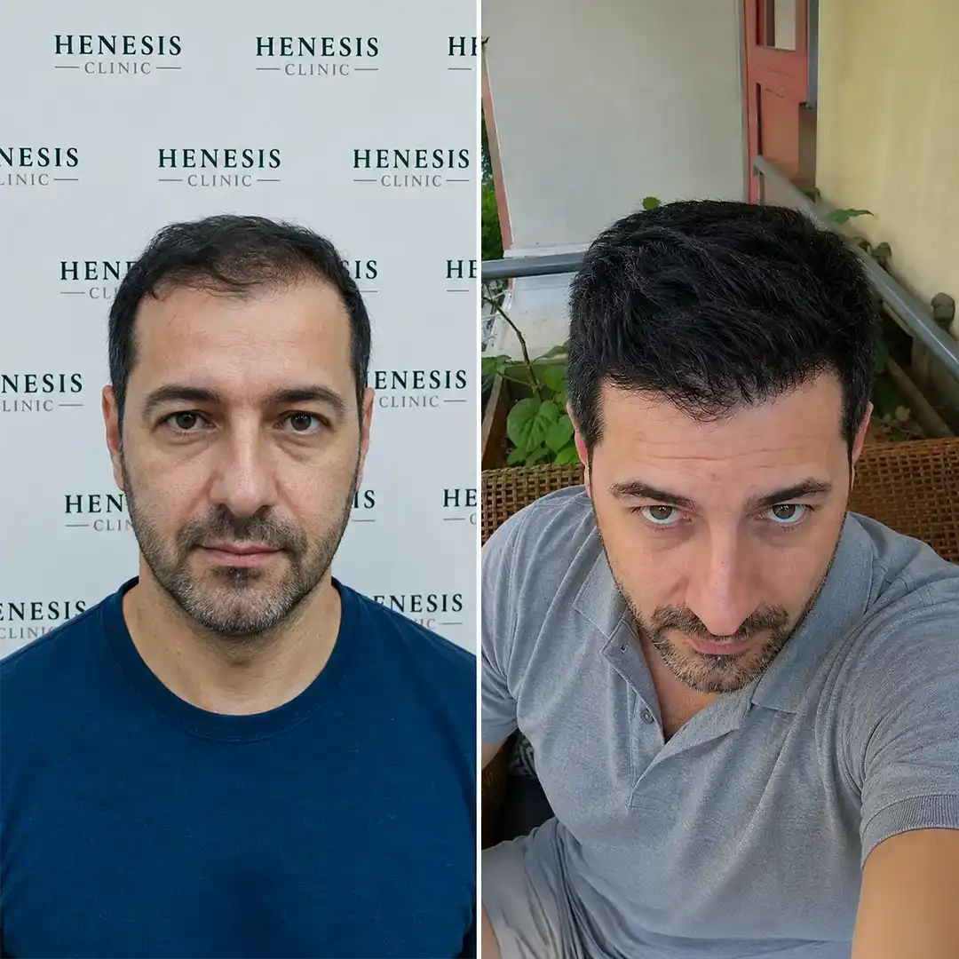 DHI hair transplant before and after result, 3,400 grafts at 12 months — case HNS-0041