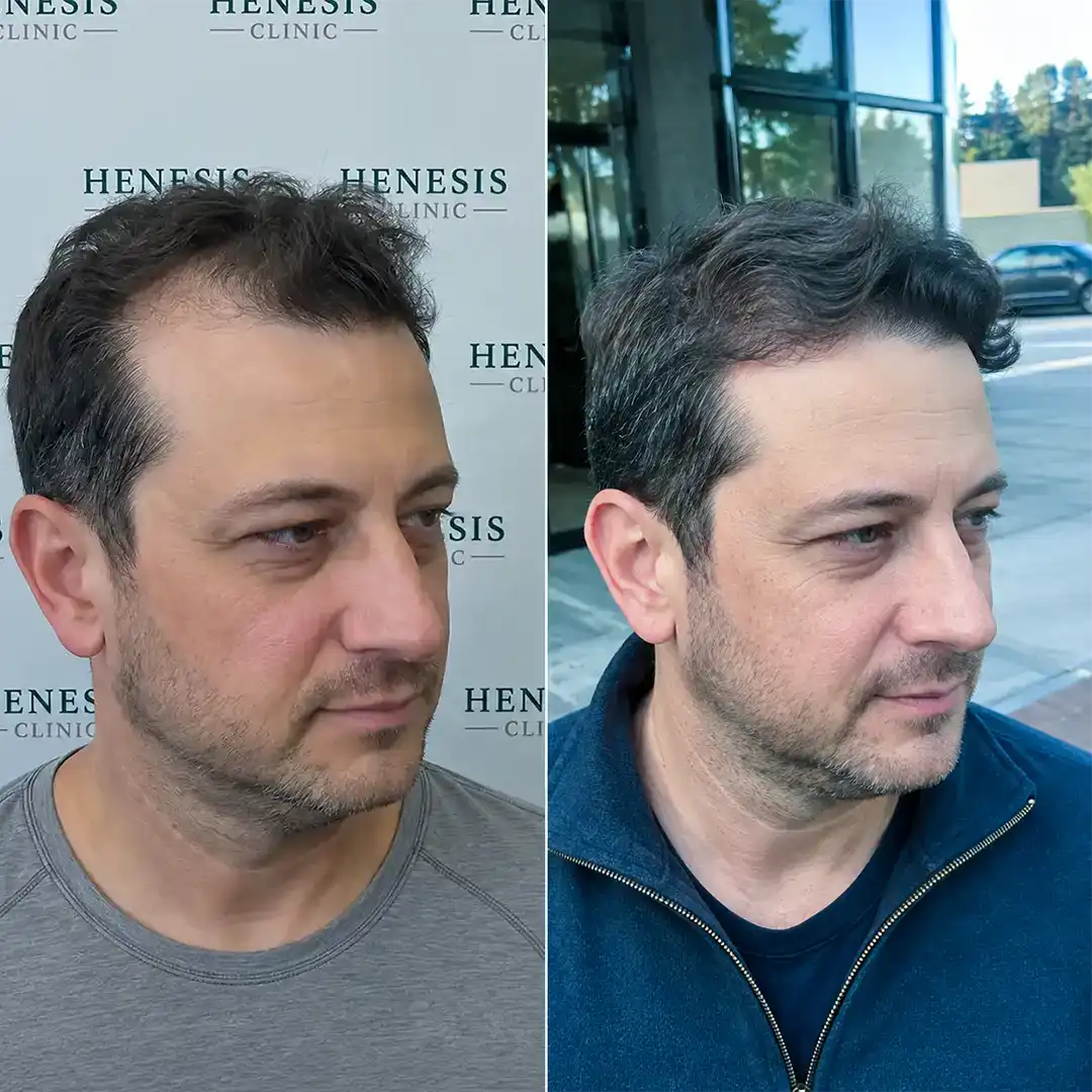 DHI hair transplant before and after result, 3,250 grafts at 12 months — case HNS-0042
