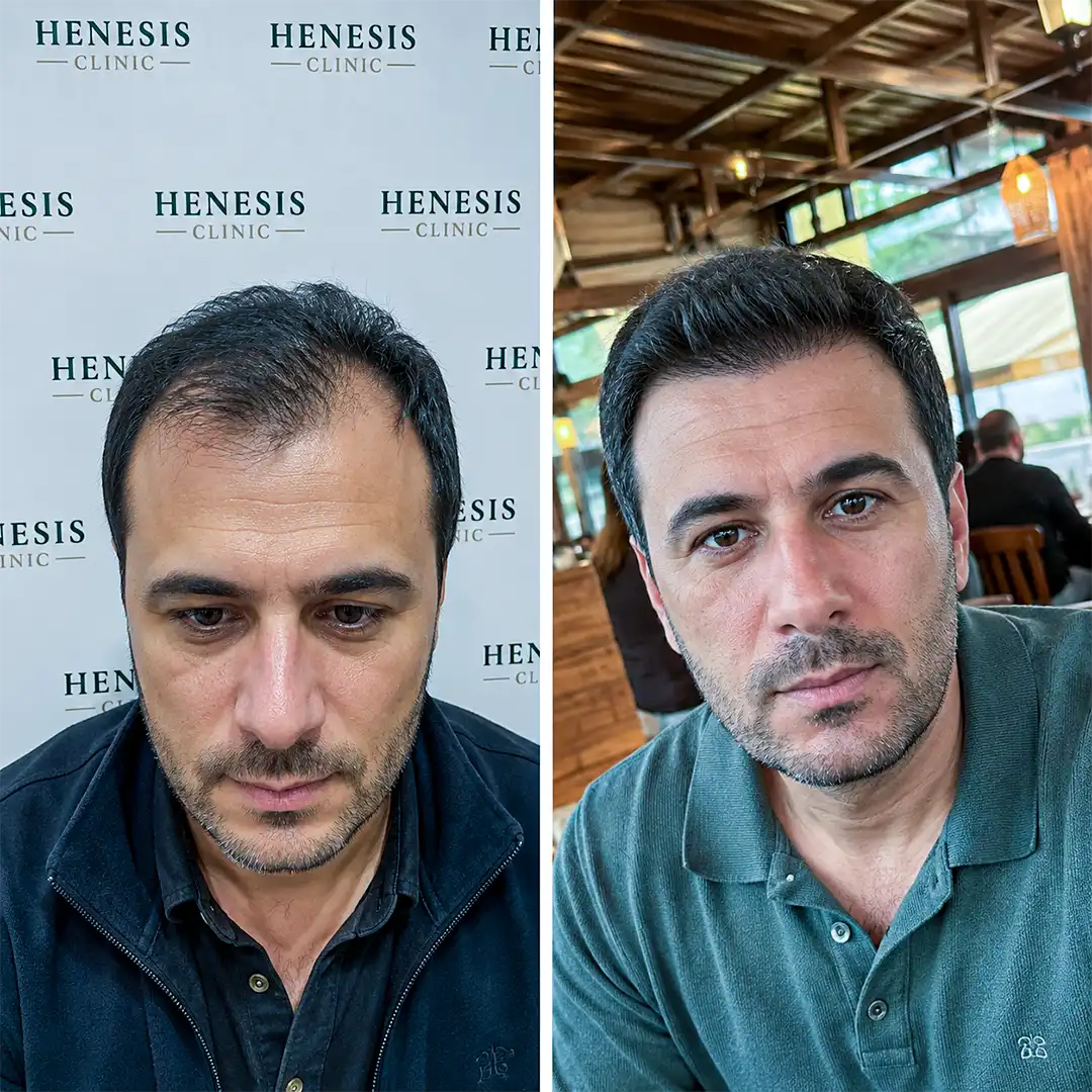 DHI hair transplant before and after result, 3,500 grafts at 12 months — case HNS-0043