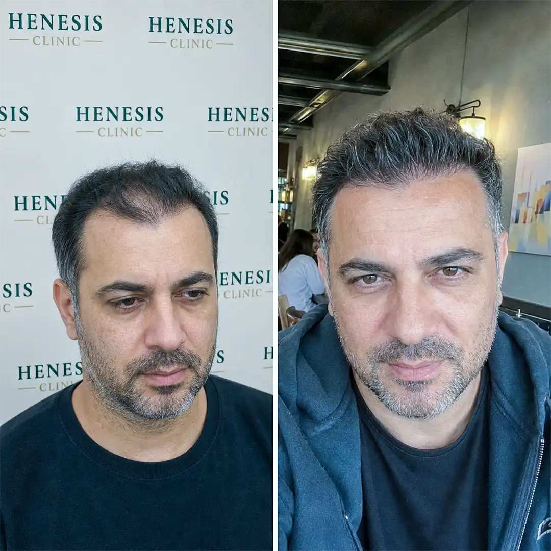 DHI hair transplant before and after result, 3,300 grafts at 12 months — case HNS-0044