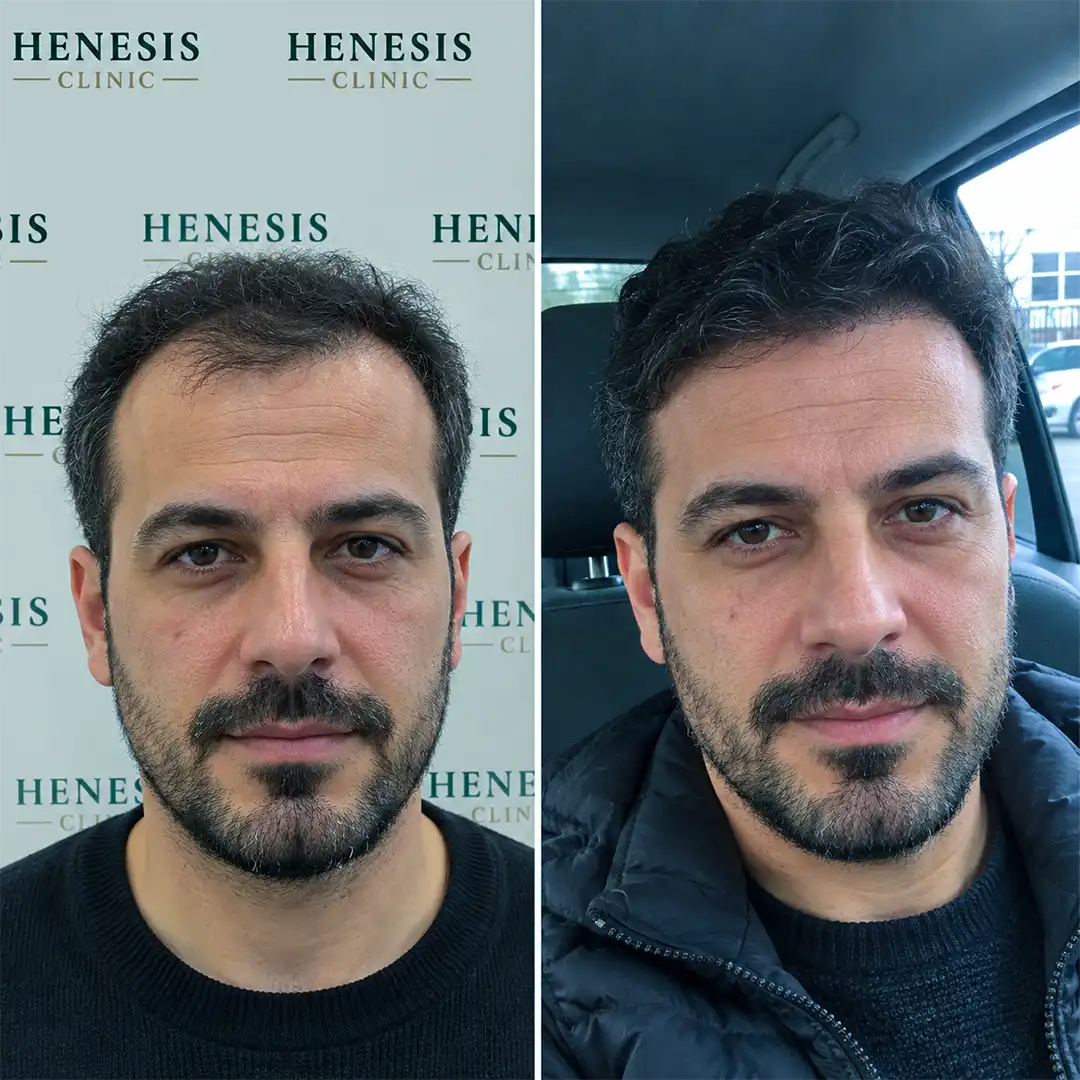 DHI hair transplant before and after result, 3,150 grafts at 12 months — case HNS-0045