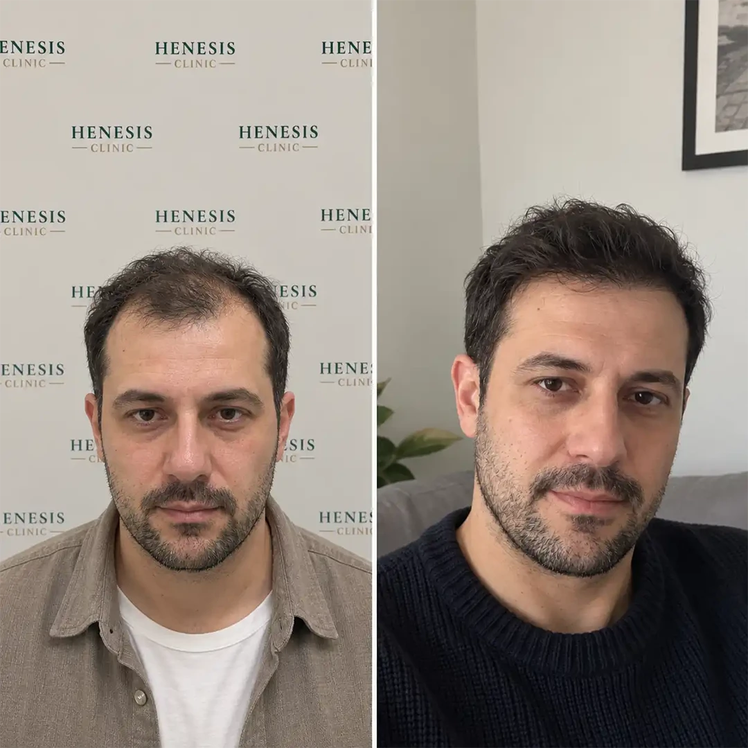 DHI hair transplant before and after result, 3,450 grafts at 12 months — case HNS-0046
