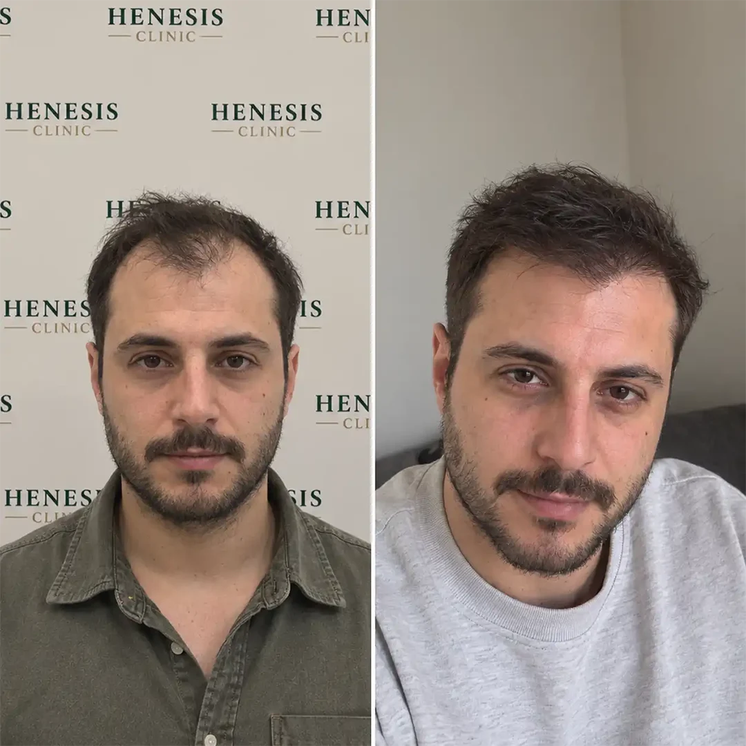 DHI hair transplant before and after result, 3,200 grafts at 12 months — case HNS-0047