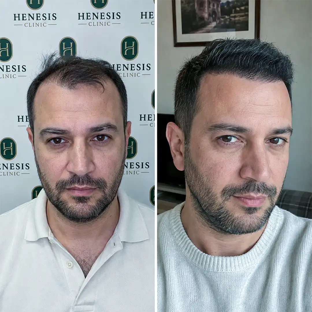 DHI hair transplant before and after result, 3,350 grafts at 12 months — case HNS-0048
