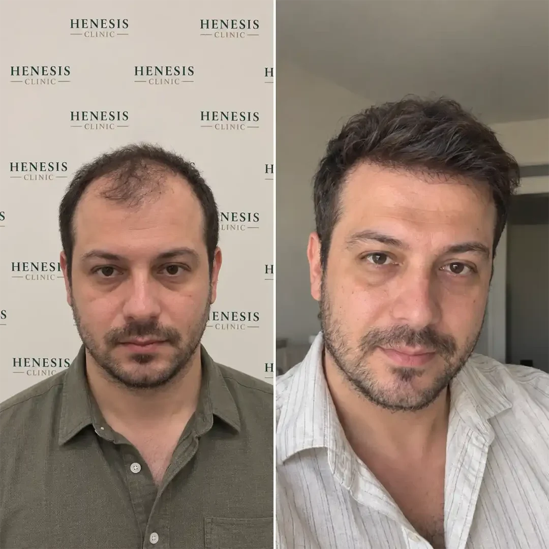 DHI hair transplant before and after result, 3,400 grafts at 12 months — case HNS-0049