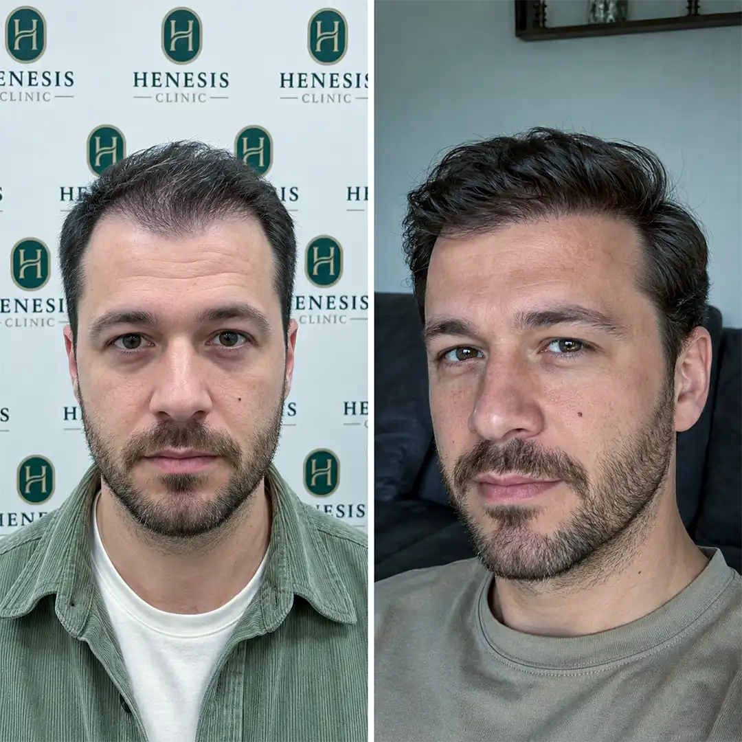 DHI hair transplant before and after result, 3,250 grafts at 12 months — case HNS-0050