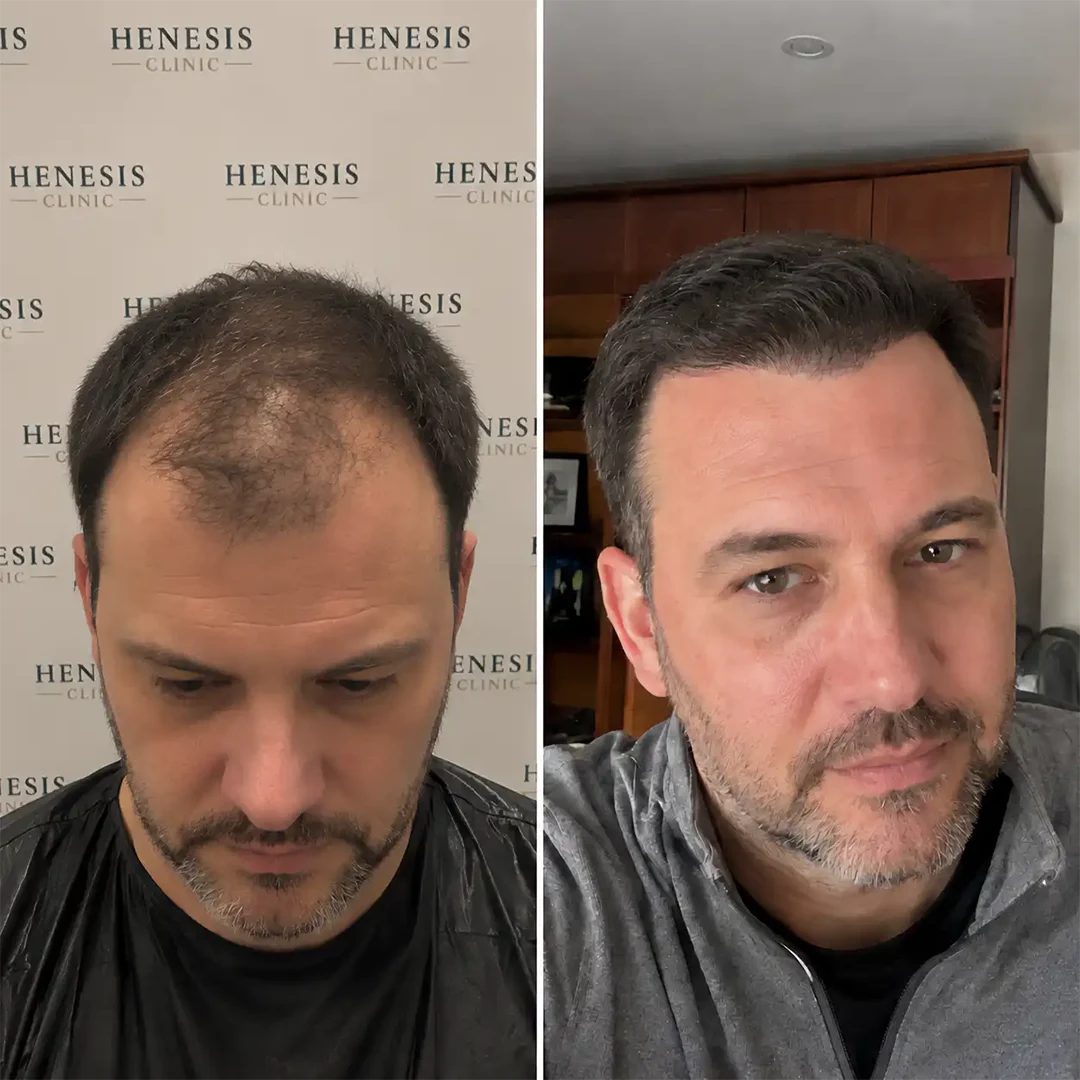DHI hair transplant before and after result, 3,300 grafts at 12 months — case HNS-0051