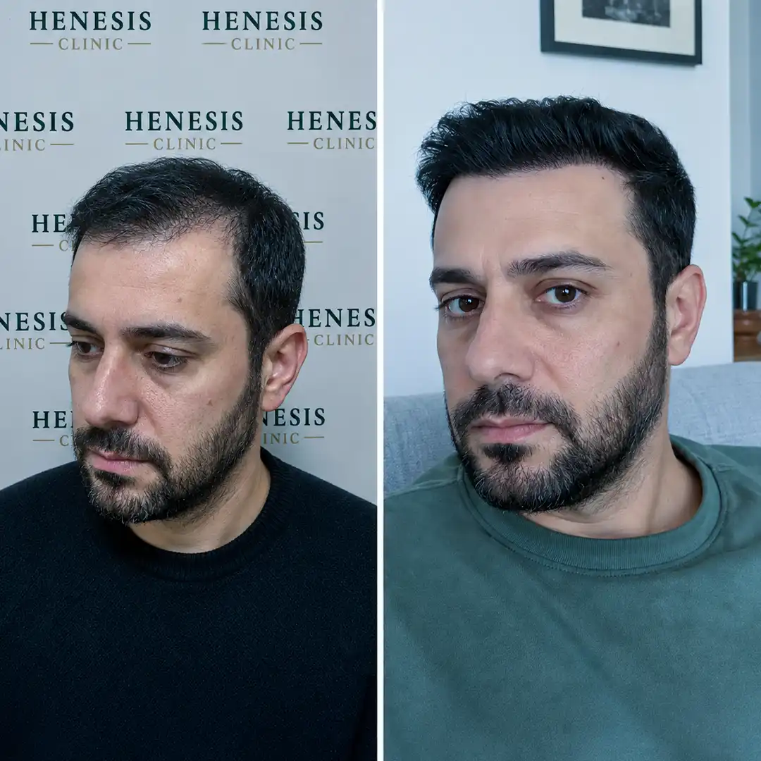 DHI hair transplant before and after result, 3,400 grafts at 12 months — case HNS-0052