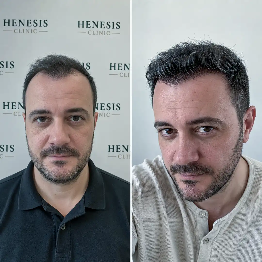 DHI hair transplant before and after result, 3,200 grafts at 12 months — case HNS-0053