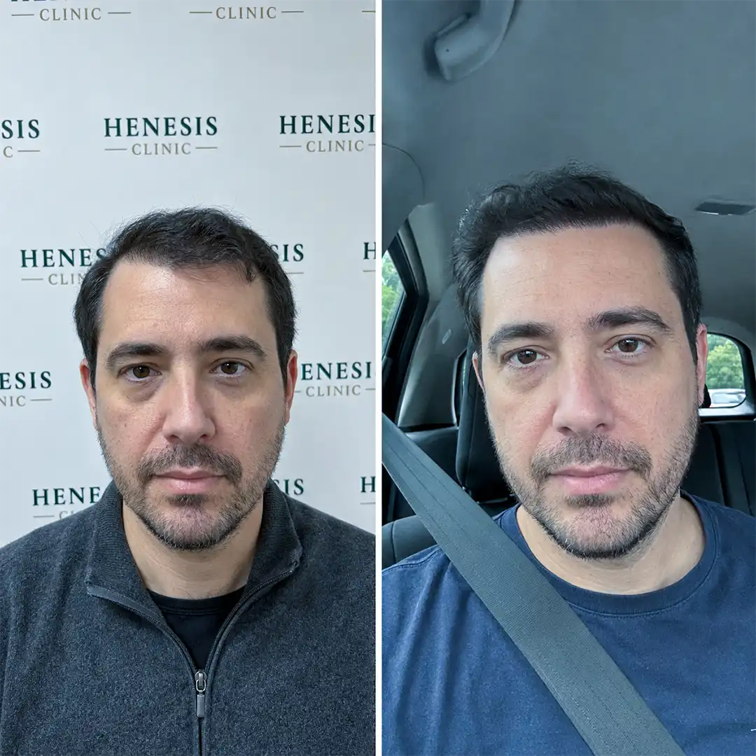 Before-treatment and 12-month follow-up photographs from documented case HNS-0054