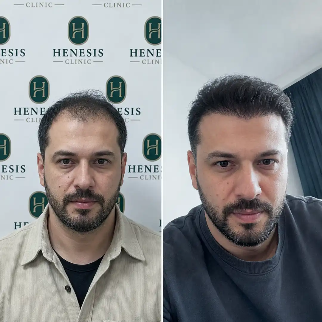Before-treatment and 12-month follow-up photographs from documented case HNS-0055