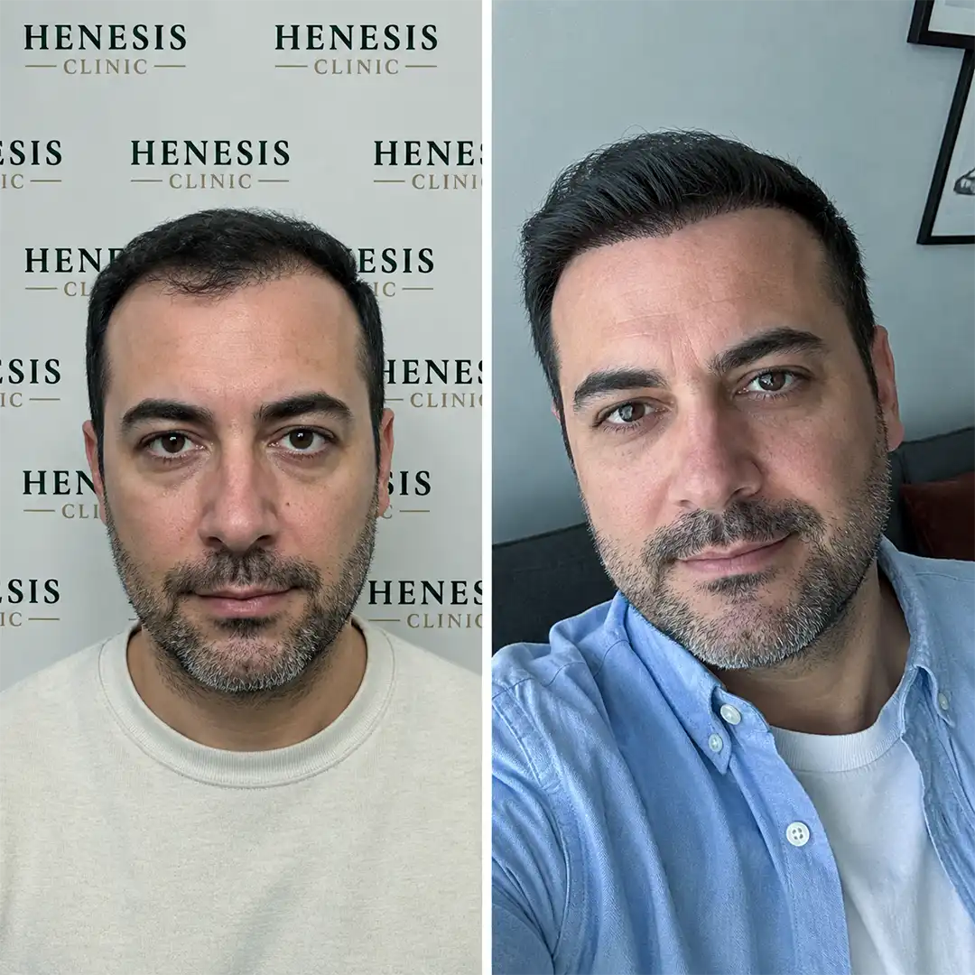 Before-treatment and 12-month follow-up photographs from documented case HNS-0056