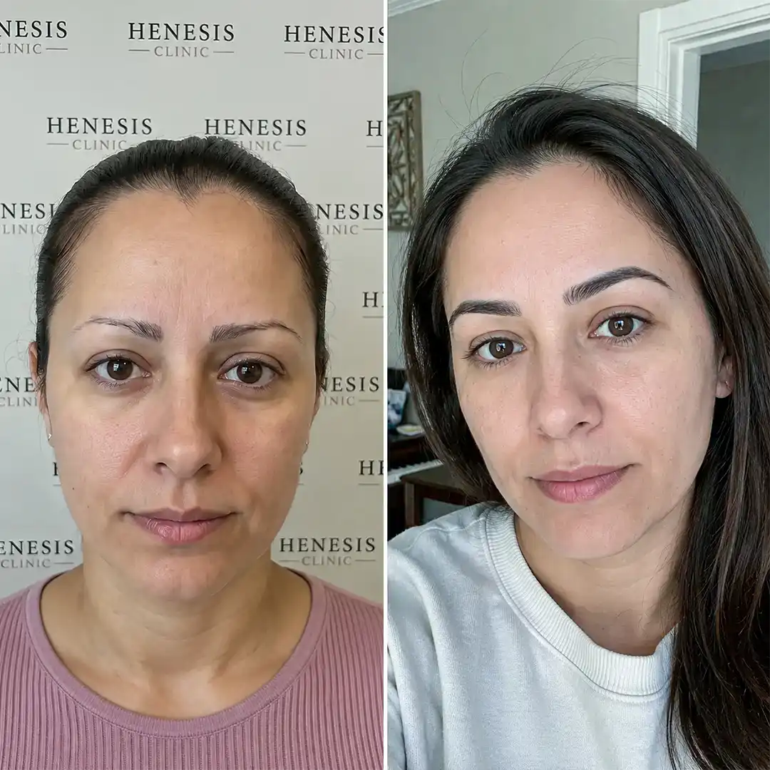 DHI eyebrow transplant before and after result, 450 grafts at 12 months — case HNS-0057