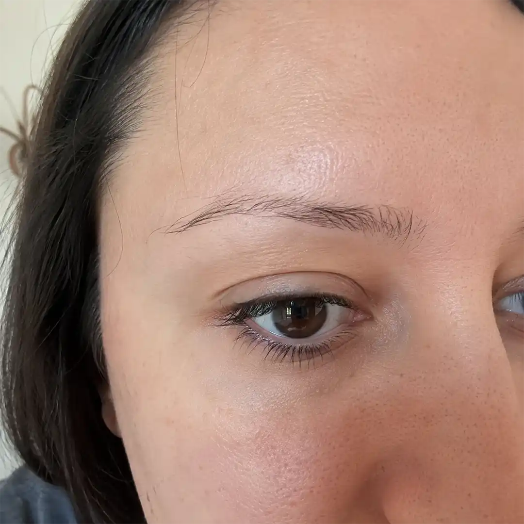 Pre-treatment front view from documented case HNS-0058