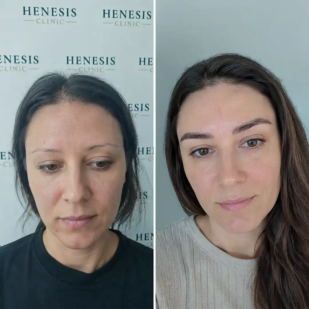 DHI eyebrow transplant before and after result, 400 grafts at 12 months — case HNS-0058