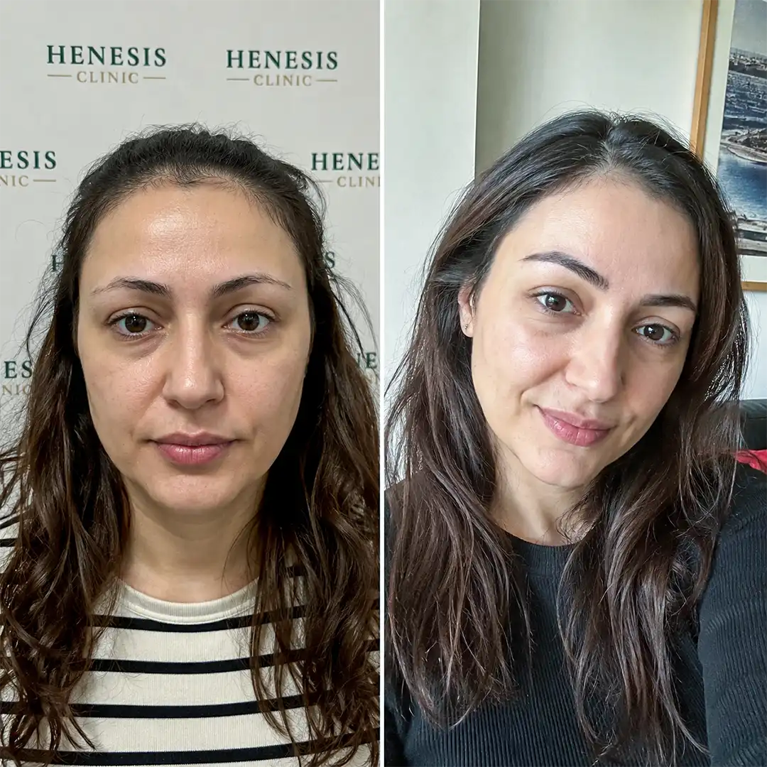DHI eyebrow transplant before and after result, 425 grafts at 12 months — case HNS-0059