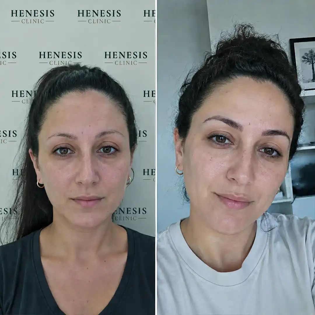 DHI eyebrow transplant before and after result, 480 grafts at 12 months — case HNS-0060