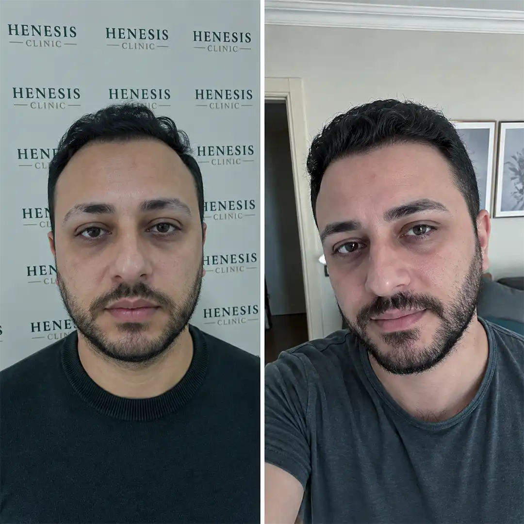 DHI eyebrow transplant before and after result, 500 grafts at 12 months — case HNS-0061