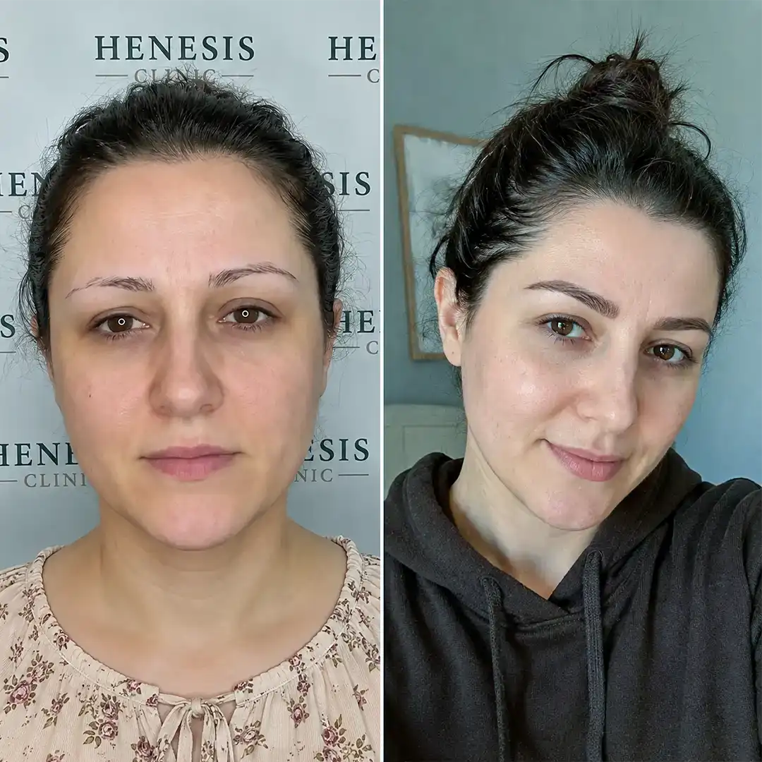 Before-treatment and 12-month follow-up photographs from documented case HNS-0062
