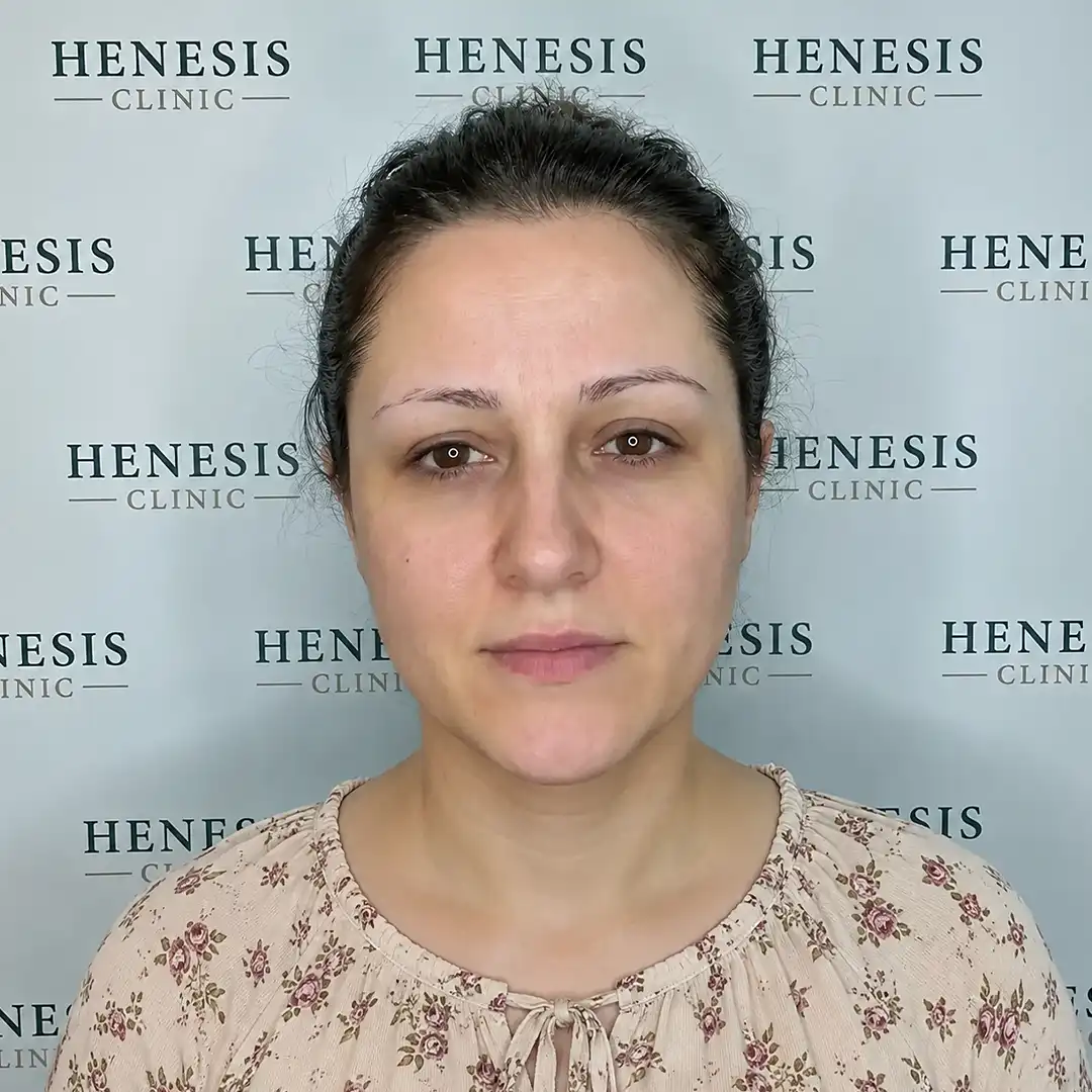 Procedure front view from documented case HNS-0062