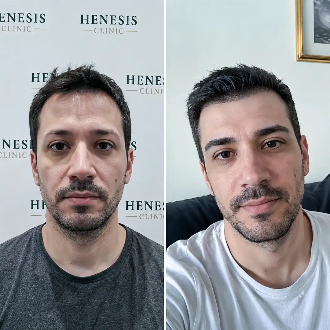 Before-treatment and 12-month follow-up photographs from documented case HNS-0063